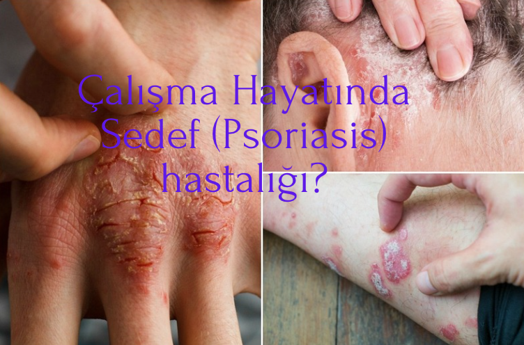 Sedef Hastalığı  (Psoriasis)