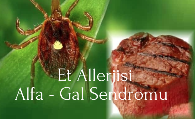 Alfa-Gal Sendromu