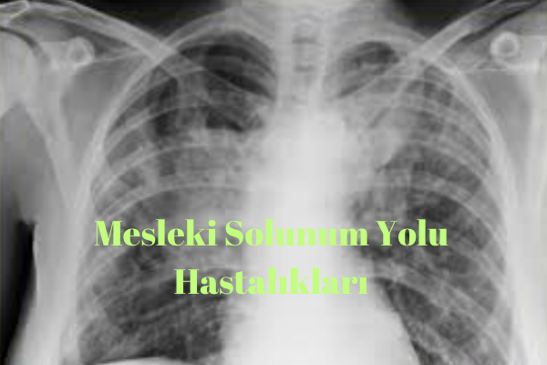 Mesleki Solunum Yolu Hastalıkları