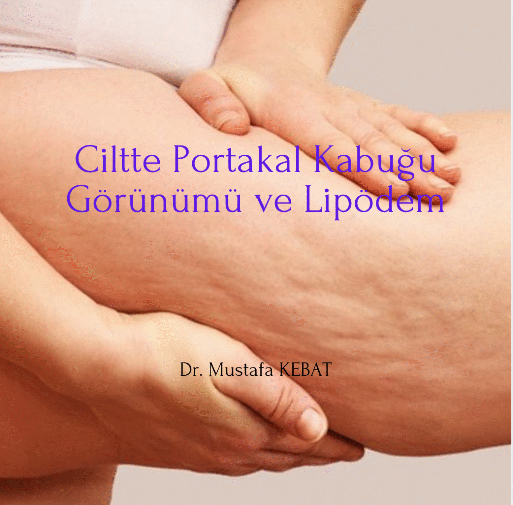 Ciltte Portakal Kabuğu Görünümü ve Lipödem